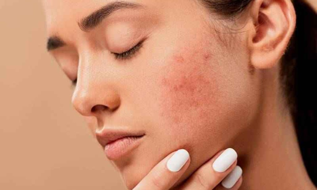 HOW TO MANAGE ACNE AND PIGMENTATION IN DRY SKIN