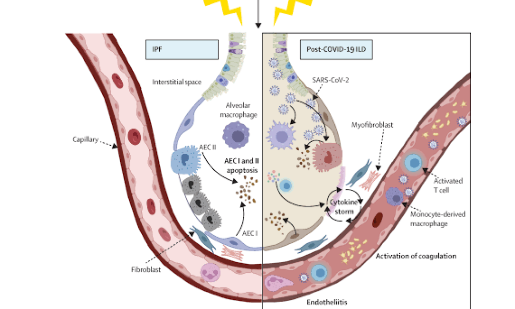 Unmasking the persistent threats of long-COVID's pulmonary sequelae