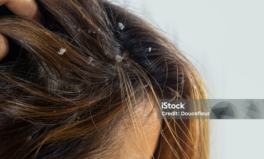 Finding the Best Suitable Treatments for Dandruff Control for Healthy Hair