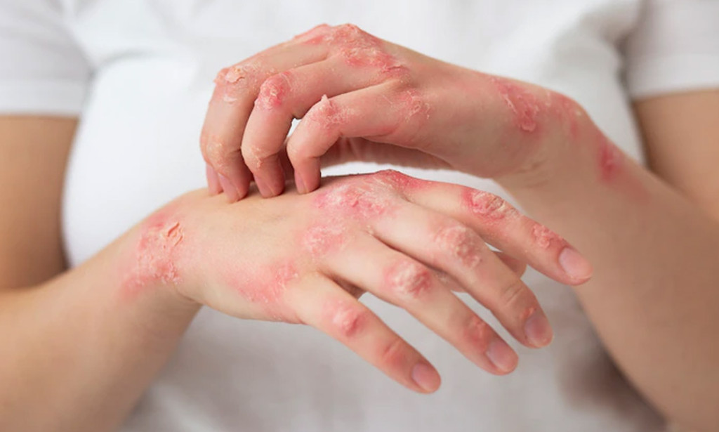 10 Effective Psoriasis Treatments: Best Products in Pakistan for 2024