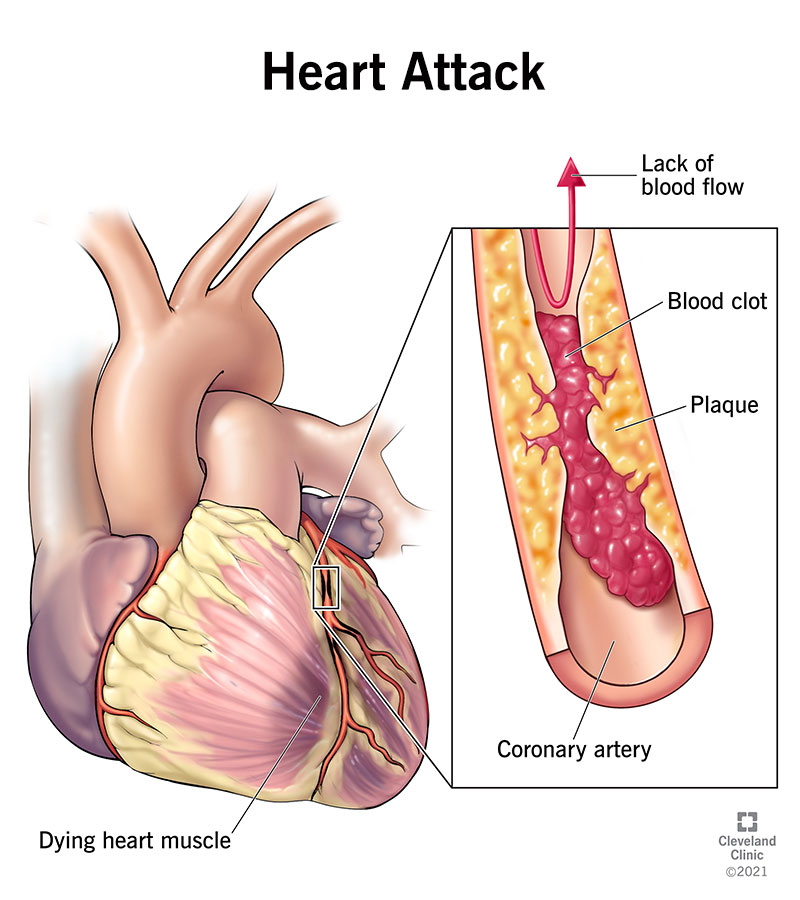 What is heart attack?