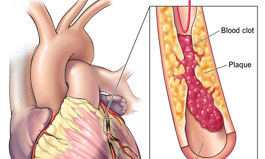 Understanding Heart Attacks: Causes, Symptoms, Prevention, and Treatment