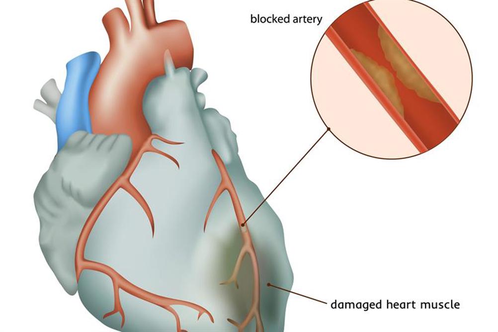What are the functions of heart attack?