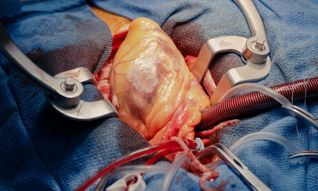 Advancements in Heart Surgery: Saving Lives with Precision and Innovation