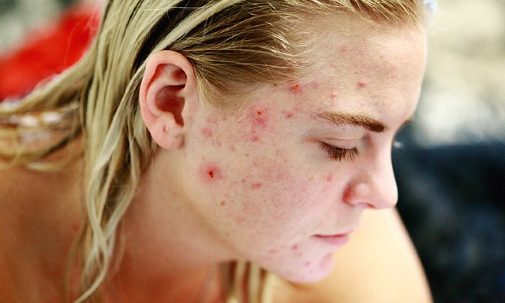 Effective Tips to Get Rid of Acne and Clear Your Skin