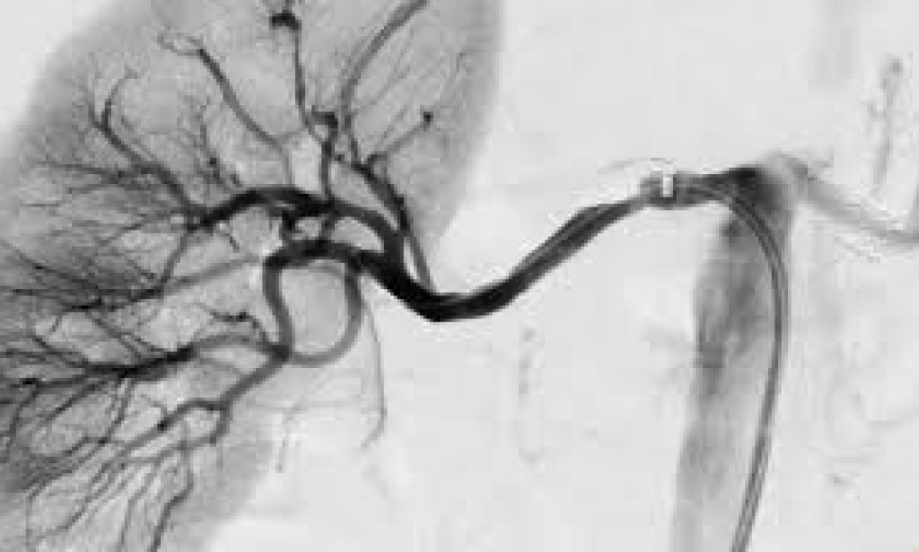 Common Causes of Kidney Failure: Key Risk Factors Explained kidney stones, drug toxicity