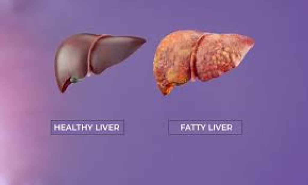 Fatty Liver Explained: Causes, Diagnosis & Warning Signs Fatty liver disease is a big health problem in Pakistan and around the world.