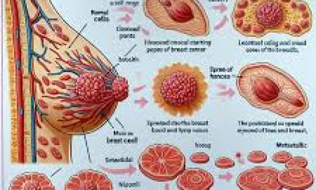 Fantasies vs Realities of Breast Malignant Growth (Cancer) treatment options,